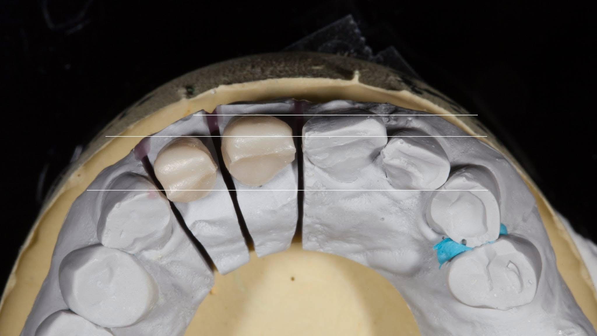 Laminate veneers on cast